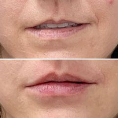 Aumento de labios - Dra. Mariela Barroso - Clínica Reabel