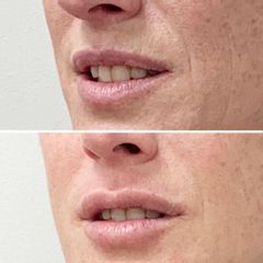 Hidratación labial y corrección de sonrisa gingival - Dra. Mariela Barroso - Clínica Reabel
