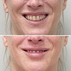 Hidratación labial y corrección de sonrisa gingival - Dra. Mariela Barroso - Clínica Reabel