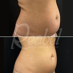 Criolipólisis - Dra. Mariela Barroso - Clínica Reabel