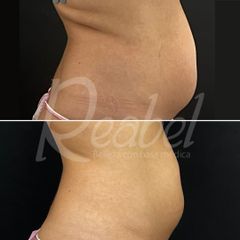 Criolipólisis - Dra. Mariela Barroso - Clínica Reabel