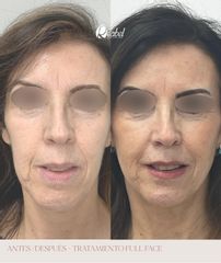 Rellenos faciales - Dra. Mariela Barroso - Clínica Reabel