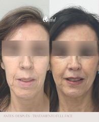 Rejuvenecimiento facial - Dra. Mariela Barroso