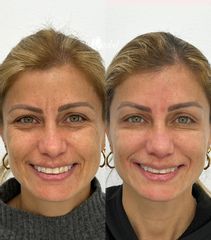 Rellenos faciales - Dra. Mariela Barroso