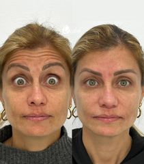 Rellenos faciales - Dra. Mariela Barroso