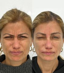Rellenos faciales - Dra. Mariela Barroso