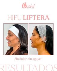 Hifu