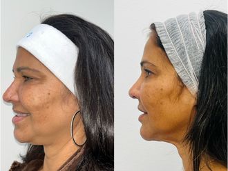 Rejuvenecimiento facial antes y después - 876537