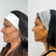 Rejuvenecimiento Facial - Clínica Reabel / Dra. Mariela Barroso