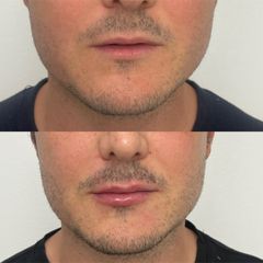 Aumento de labios