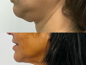 Eliminar grasa localizada antes y después - 877382