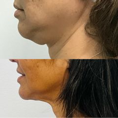 Reducción papada, y  flacidez