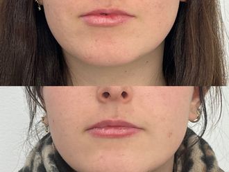 Aumento labios antes y después - 878719