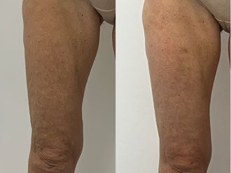 Mesoterapia antes y después - 878989
