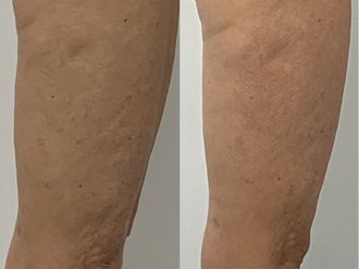 Mesoterapia antes y después - 878990
