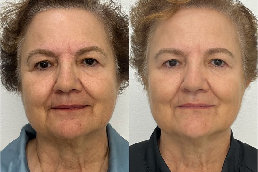HIFU antes y después - 879714