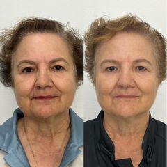 Rejuvenecer no invasivo