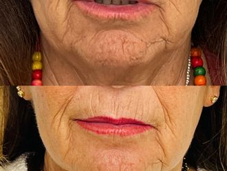 Rejuvenecimiento facial antes y después - 880087
