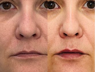 Aumento labios antes y después - 880253