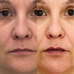 Hialuronico Labios - Clínica Reabel - Dra. Mariela Barroso