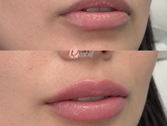 Aumento labios antes y después - 881448