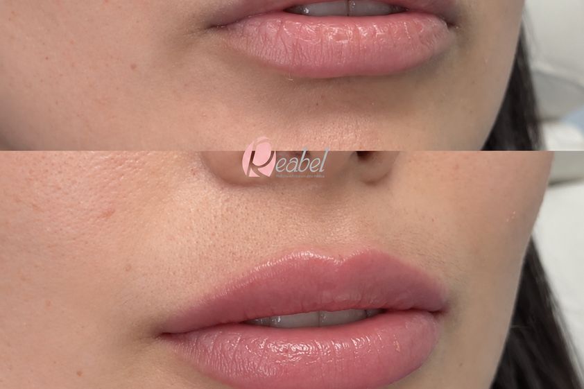 Aumento labios antes y después - 881448