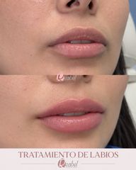 Aumento de labios