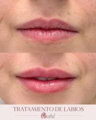 Aumento de labios - Clínica Reabel - Dra. Mariela Barroso
