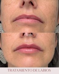 Aumento de labios - Clínica Reabel - Dra. Mariela Barroso