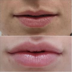 Antes y después Aumento de labios - CosMédica
