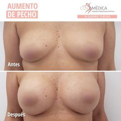Antes y después Aumento de pecho - CosMédica