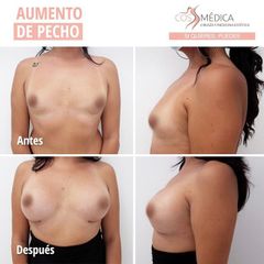Antes y después Aumento de pecho - CosMédica