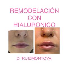 Aumento de labios - Dr. Ruiz Montoya