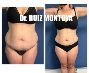 Abdominoplastia - Dr. Ruiz Montoya