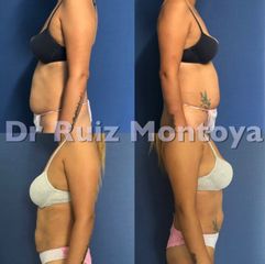 Lipoláser - Dr. Ruiz Montoya