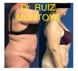 Abdominoplastia - Dr. Ruiz Montoya