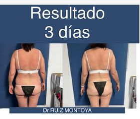 Lipoláser - Dr. Ruiz Montoya