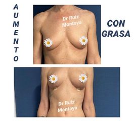 Aumento de pecho - Dr. Ruiz Montoya