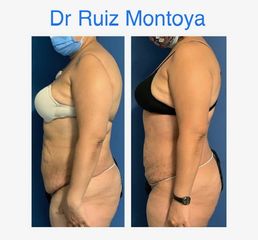 Lipoláser - Dr. Ruiz Montoya
