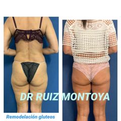 Aumento de glúteos - Dr. Ruiz Montoya