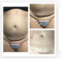 Abdominoplastia - Dr. Ruiz Montoya