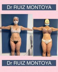 Lipoláser - Dr. Ruiz Montoya