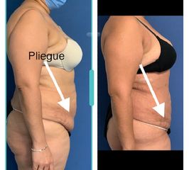 Abdominoplastia - Dr. Ruiz Montoya