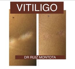 Vitiligio - Dr. Ruiz Montoya