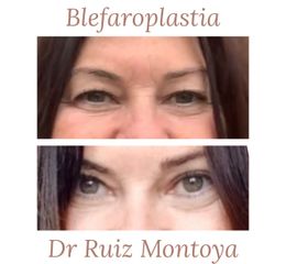 Blefaroplastia - Dr. Ruiz Montoya
