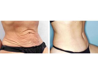 Abdominoplastia - Dr. Ramón Vila-Rovira