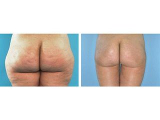 Liposucción - Dr. Ramón Vila-Rovira