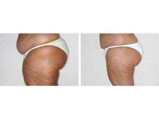 Liposucción - Dr. Ramón Vila-Rovira