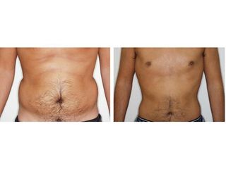 Liposucción - Dr. Ramón Vila-Rovira