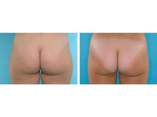 Liposucción - Dr. Ramón Vila-Rovira